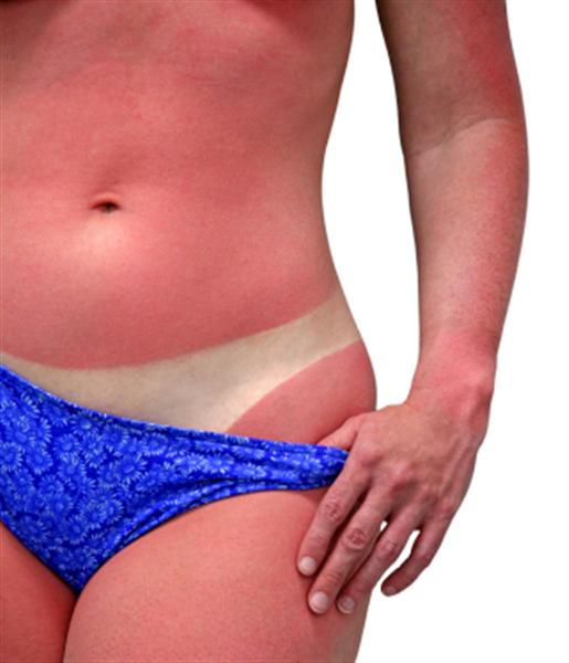 Sunce i more - kako se zaštiti od opeklina, crvenila, osipa....
